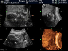 Vivian Sonograms